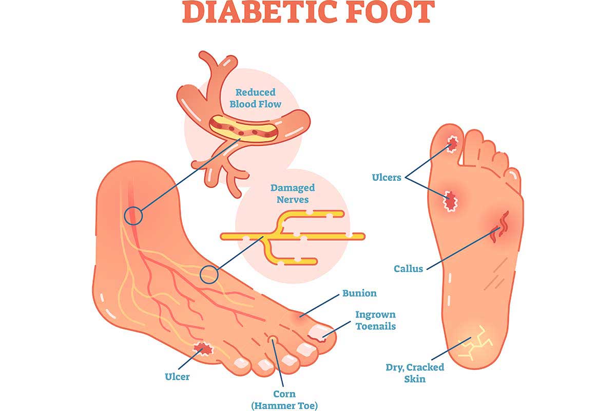 Piede Diabetico