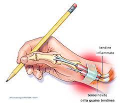 Sindrome di De Quervain